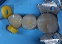 Αποκατάσταση οπισθιου δοντιού με σύνθετη ρητίνη 